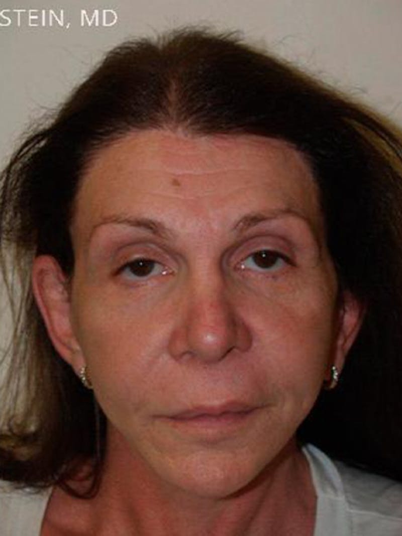 Hair for Gender Reaffirmation Before & After Gallery - Patient 104697 - Image 2