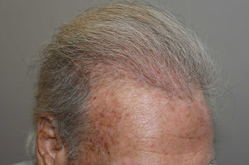 Body Hair Transplants Before & After Gallery - Patient 242865 - Image 6