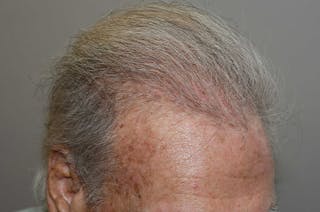 Body Hair Transplants Before & After Gallery - Patient 109577 - Image 8