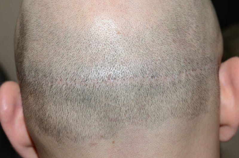 Hair Transplant Repair Before & After Gallery - Patient 137153 - Image 2