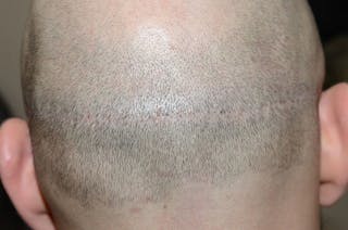 Hair Transplant Repair Before & After Gallery - Patient 205133 - Image 2
