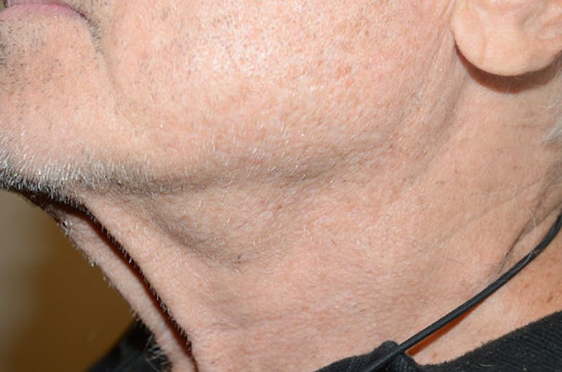 Body Hair Transplants Before & After Gallery - Patient 242865 - Image 7