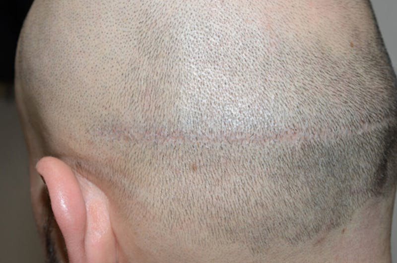 Hair Transplant Repair Before & After Gallery - Patient 137153 - Image 4