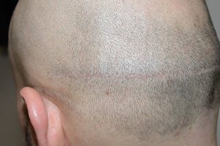 Hair Transplant Repair Before & After Gallery - Patient 205133 - Image 4