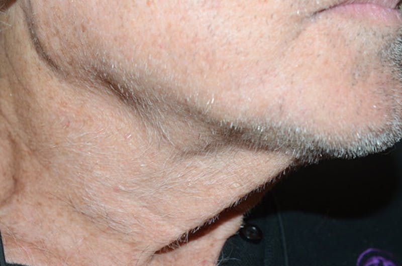 Body Hair Transplants Before & After Gallery - Patient 242865 - Image 8