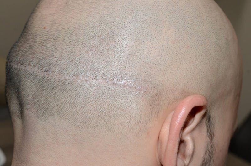 Hair Transplant Repair Before & After Gallery - Patient 137153 - Image 6