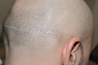 Hair Transplant Repair Before & After Gallery - Patient 205133 - Image 6
