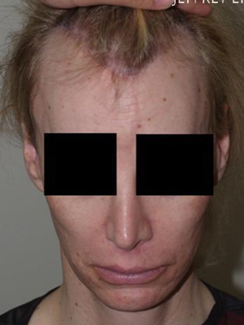 Hair for Gender Reaffirmation Before & After Gallery - Patient 145586 - Image 1