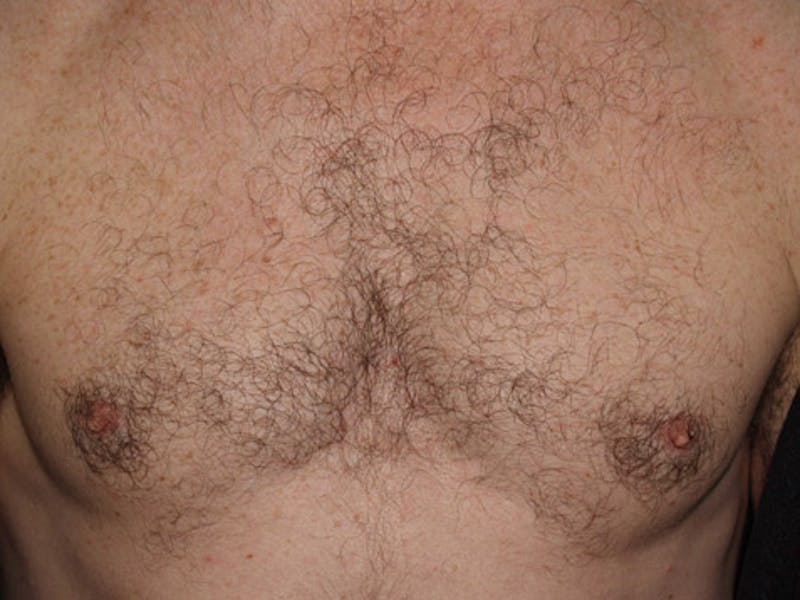 Body Hair Transplants Before & After Gallery - Patient 240624 - Image 1