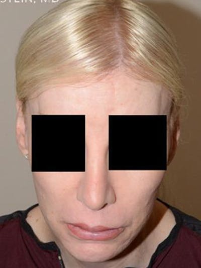 Hair For Gender Reaffirmation Before & After Gallery - Patient 403828 - Image 2