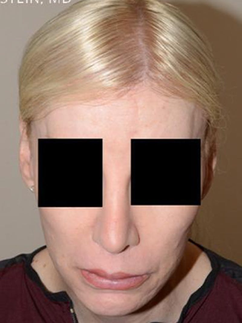 Hair for Gender Reaffirmation Before & After Gallery - Patient 145586 - Image 2