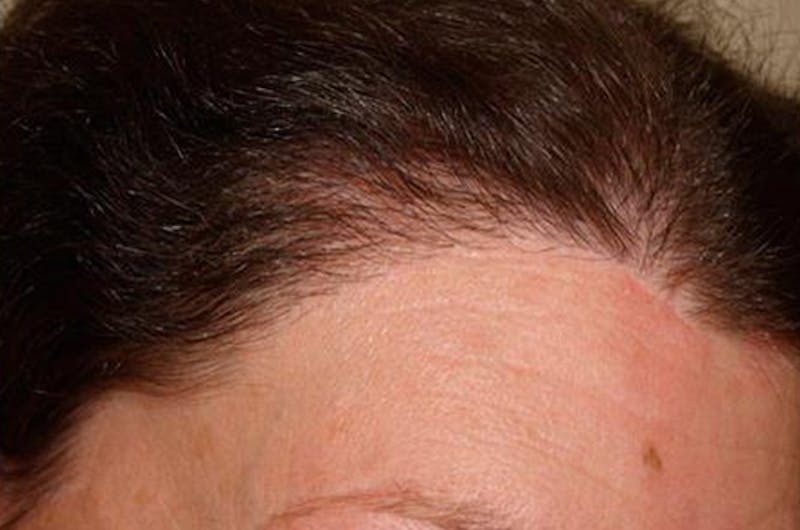 Hair for Gender Reaffirmation Before & After Gallery - Patient 104697 - Image 8