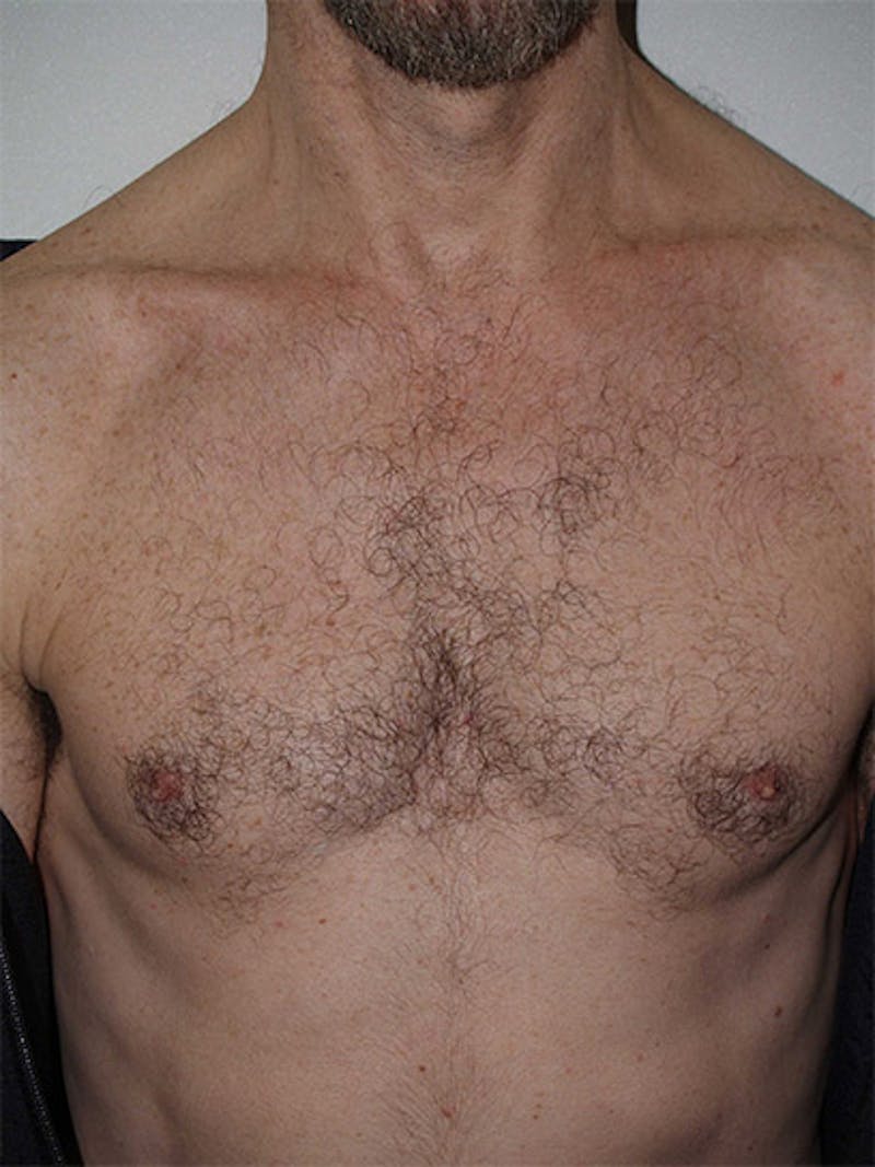Body Hair Transplants Before & After Gallery - Patient 240624 - Image 3