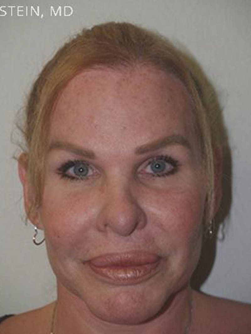 Hairline Lowering Surgery Before & After Gallery - Patient 417733 - Image 2