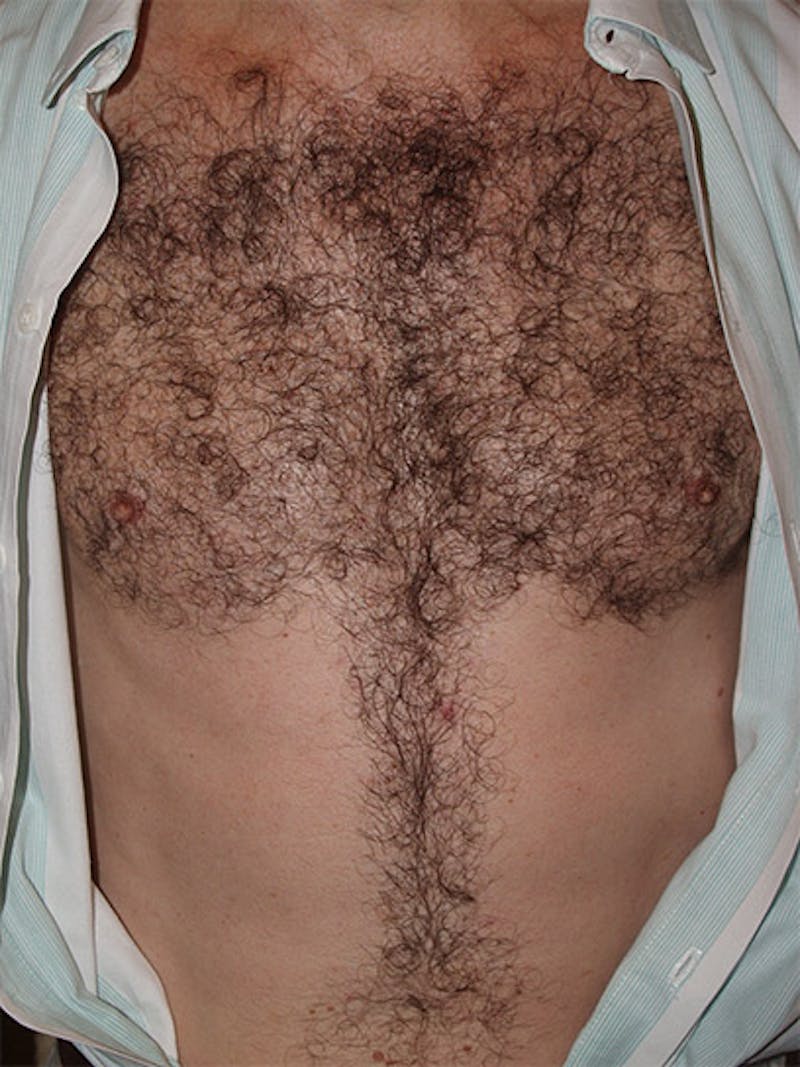 Body Hair Transplants Before & After Gallery - Patient 240624 - Image 4