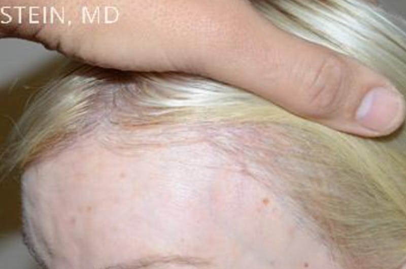 Hair for Gender Reaffirmation Before & After Gallery - Patient 145586 - Image 6