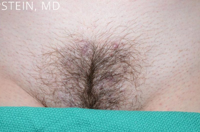 Body Hair Transplants Before & After Gallery - Patient 408872 - Image 2