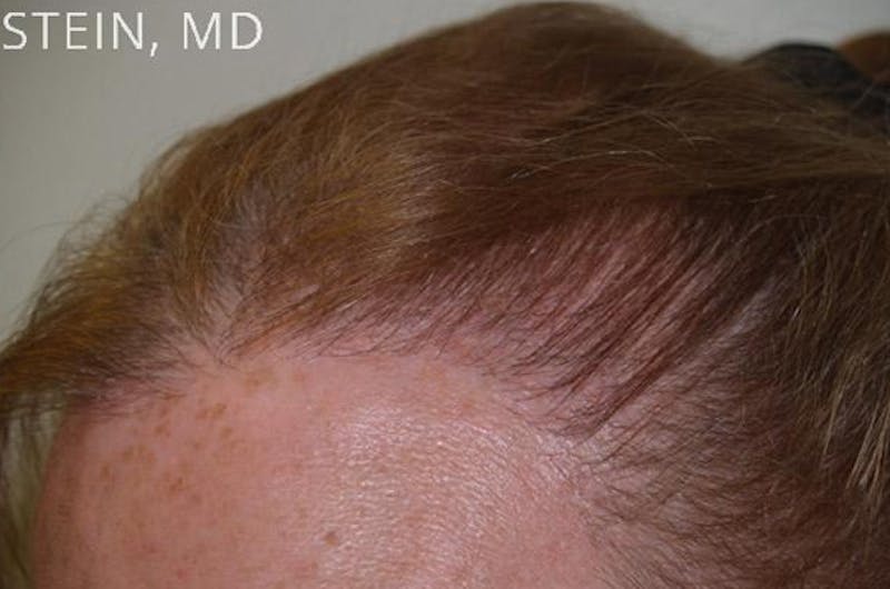 Hairline Lowering Surgery Before & After Gallery - Patient 417733 - Image 8