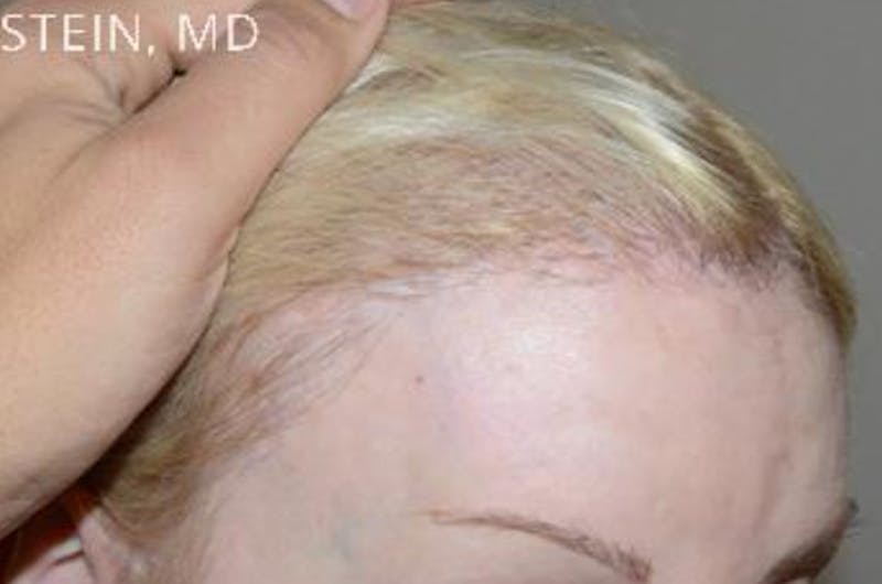 Hair for Gender Reaffirmation Before & After Gallery - Patient 145586 - Image 8