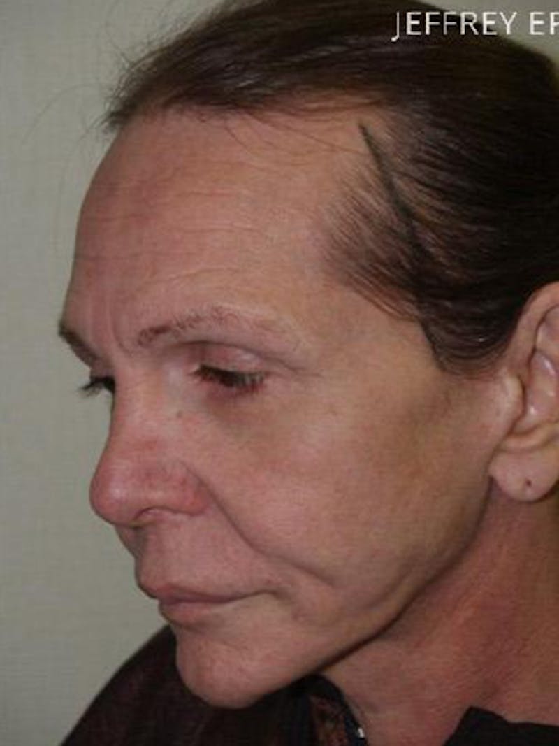 Hair for Gender Reaffirmation Before & After Gallery - Patient 104697 - Image 3