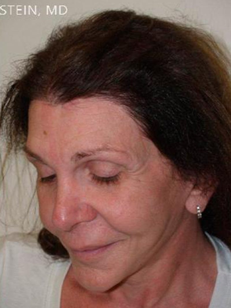 Hair for Gender Reaffirmation Before & After Gallery - Patient 104697 - Image 4