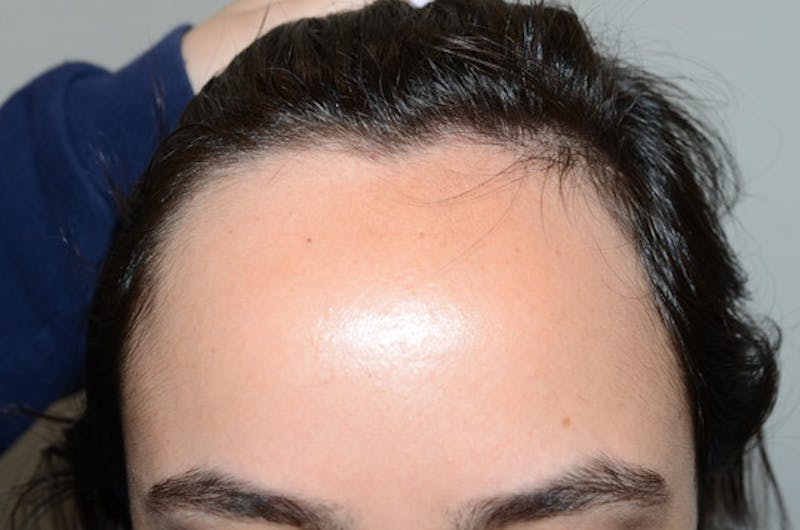 Hair Procedures for Women Before & After Gallery - Patient 144295 - Image 1