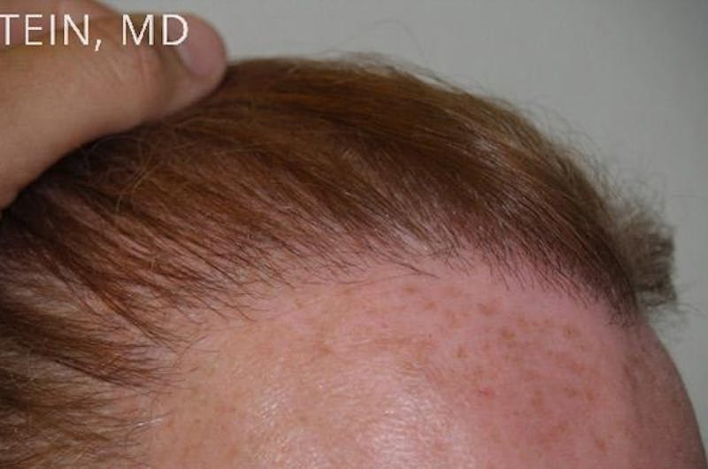 Hairline Lowering Surgery Before & After Gallery - Patient 417733 - Image 10