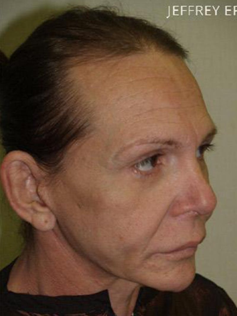 Hair for Gender Reaffirmation Before & After Gallery - Patient 104697 - Image 5