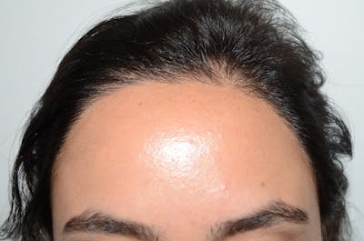 Hair Procedures for Women Before & After Gallery - Patient 252661 - Image 2