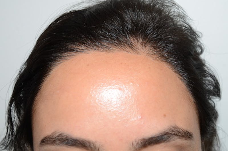 Hair Procedures for Women Before & After Gallery - Patient 144295 - Image 2