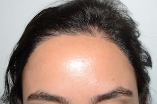 Hair Procedures for Women Before & After Gallery - Patient 620137 - Image 2