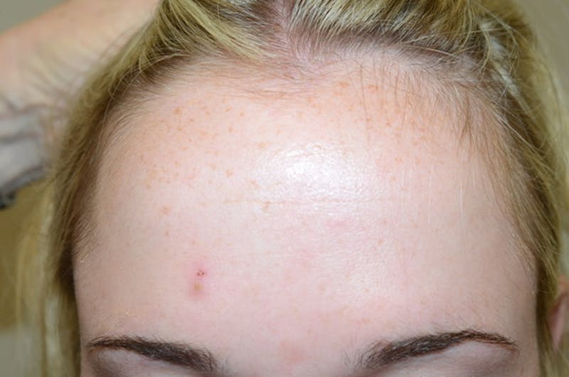 Hairline Lowering Surgery Before & After Gallery - Patient 275317 - Image 1
