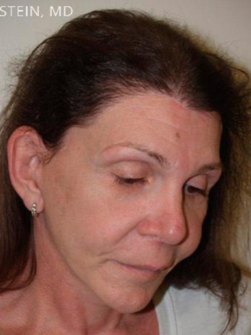 Hair for Gender Reaffirmation Before & After Gallery - Patient 104697 - Image 6