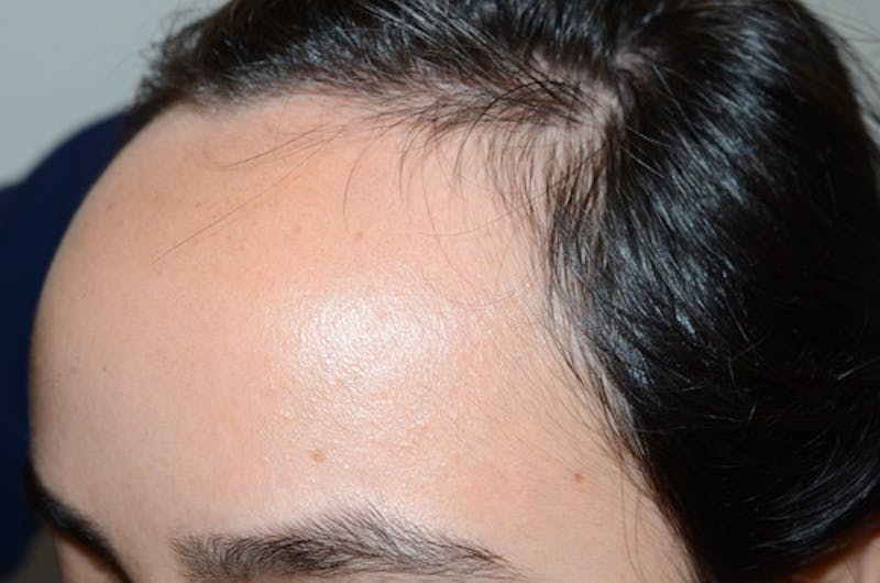 Hair Procedures for Women Before & After Gallery - Patient 144295 - Image 3