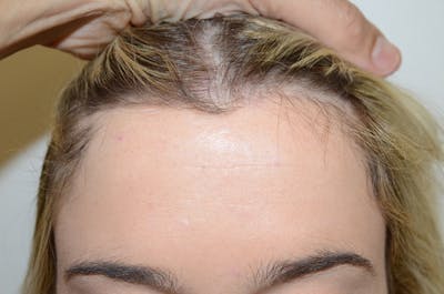 Hairline Lowering Surgery Before & After Gallery - Patient 284685 - Image 2