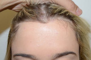 Hairline Lowering Surgery Before & After Gallery - Patient 275317 - Image 2