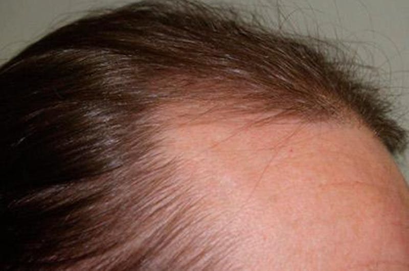 Hair for Gender Reaffirmation Before & After Gallery - Patient 104697 - Image 7