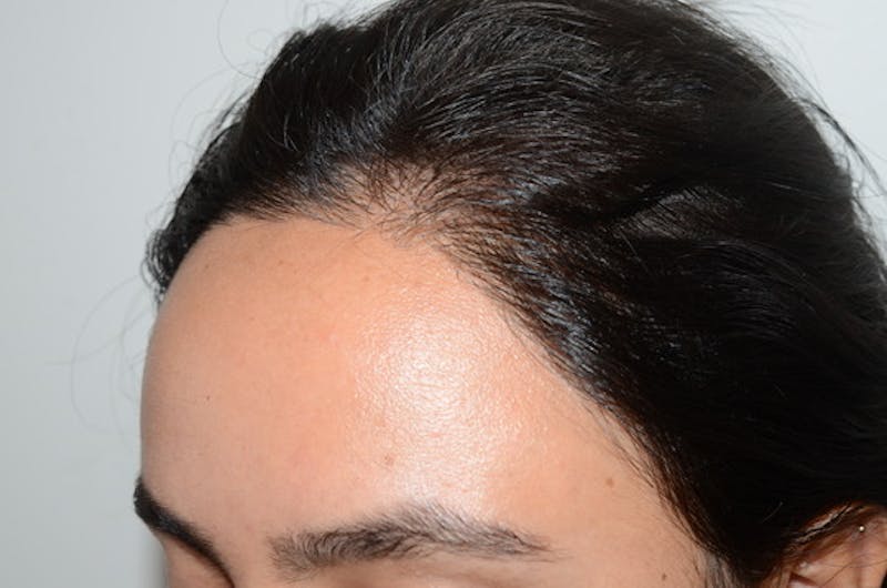 Hair Procedures for Women Before & After Gallery - Patient 144295 - Image 4