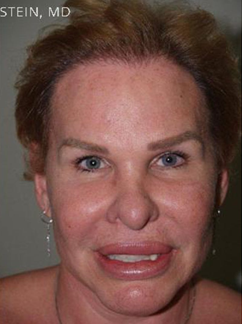 Hair for Gender Reaffirmation Before & After Gallery - Patient 902722 - Image 2