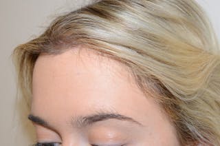 Hairline Lowering Surgery Before & After Gallery - Patient 275317 - Image 4