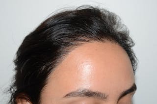 Hair Procedures for Women Before & After Gallery - Patient 620137 - Image 6