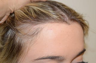 Hairline Lowering Surgery Before & After Gallery - Patient 275317 - Image 6