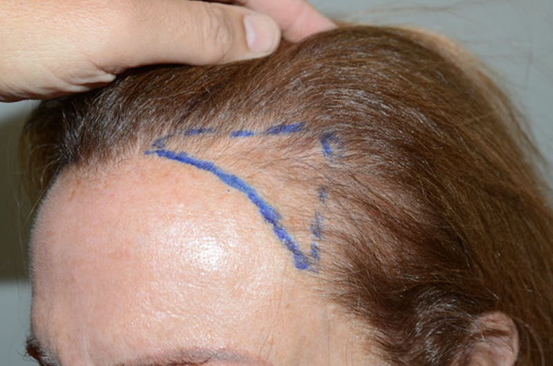 Hair Procedures for Women Before & After Gallery - Patient 361500 - Image 1