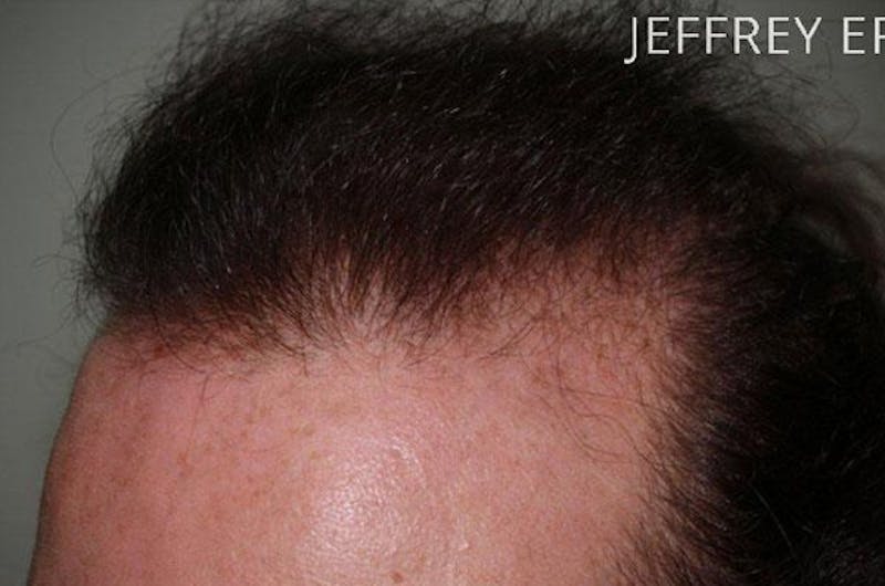 Hair for Gender Reaffirmation Before & After Gallery - Patient 902722 - Image 7