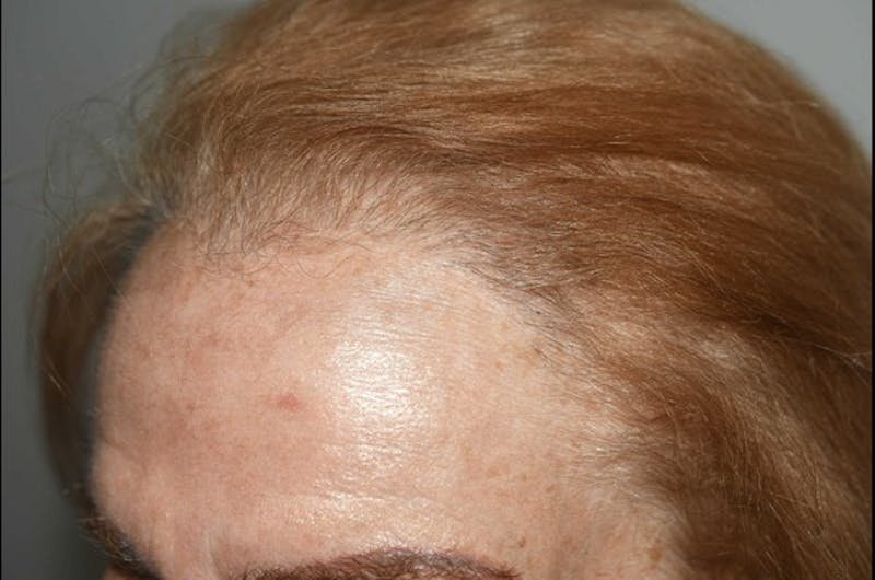 Hair Procedures for Women Before & After Gallery - Patient 361500 - Image 2