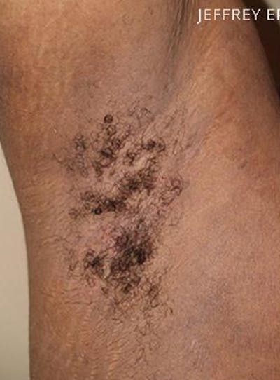 Body Hair Transplants Before & After Gallery - Patient 226580 - Image 1