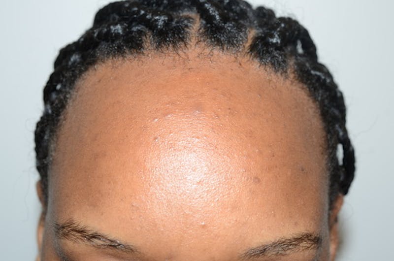 Hairline Lowering Surgery Before & After Gallery - Patient 435634 - Image 1