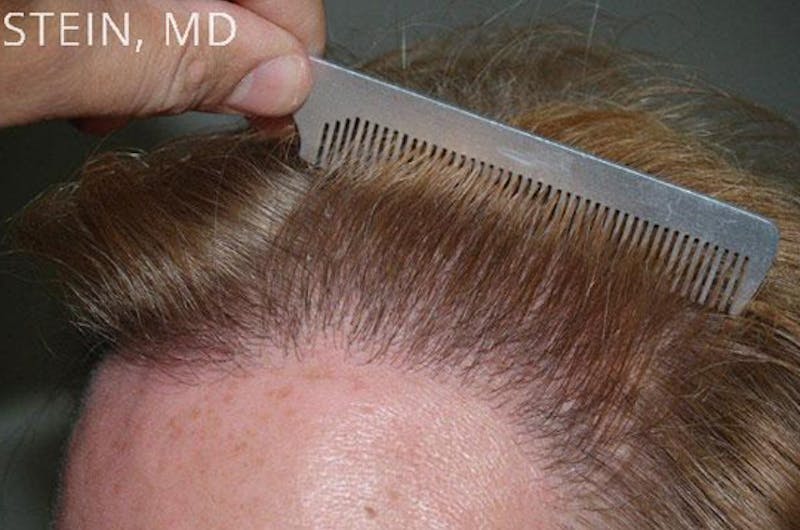 Hair for Gender Reaffirmation Before & After Gallery - Patient 902722 - Image 8