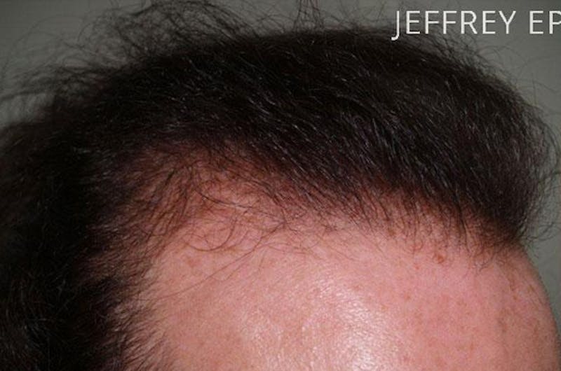 Hair for Gender Reaffirmation Before & After Gallery - Patient 902722 - Image 9