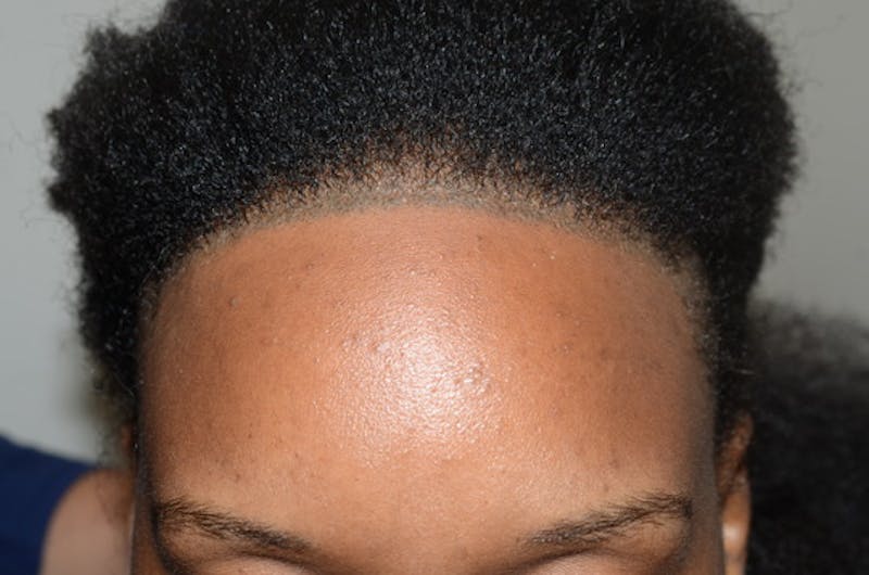 Hairline Lowering Surgery Before & After Gallery - Patient 435634 - Image 2